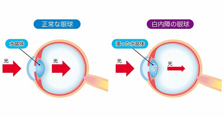 白内障になりやすい人や年齢ってあるの？