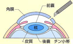 眼球を切開し、水晶体の前嚢を切り取る。