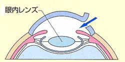 残した嚢の中に、眼内レンズを挿入する