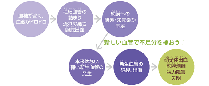 どうして糖尿病で眼が病気になるの？原因は？
