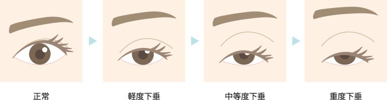 眼瞼下垂（がんけんかすい）とは