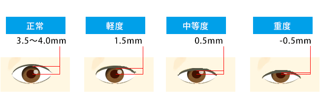 眼瞼下垂の程度