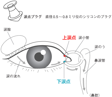 涙点プラグによる治療