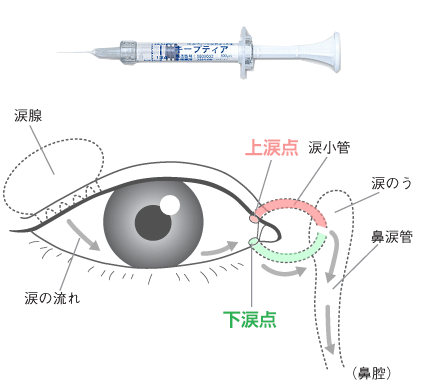 キープティアによる治療