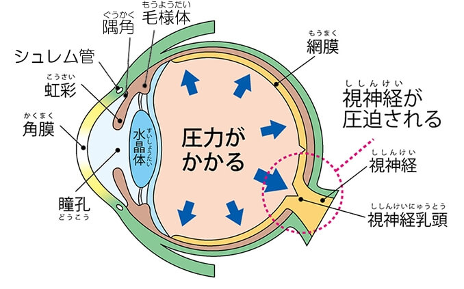 緑内障とはどのような病気？