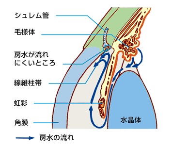 原発開放隅角緑内障