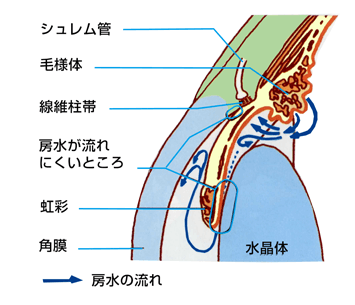 原発閉塞隅角緑内障