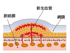 加齢黄斑変性の種類