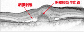 滲出型加齢黄斑変性の黄斑像