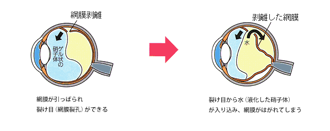 網膜剥離とは