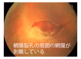 網膜剥離の眼底