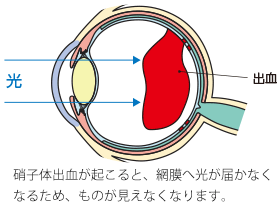 網膜静脈分枝閉塞症