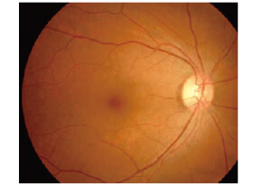 網膜中心静脈閉塞症