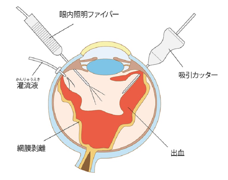 硝子体手術