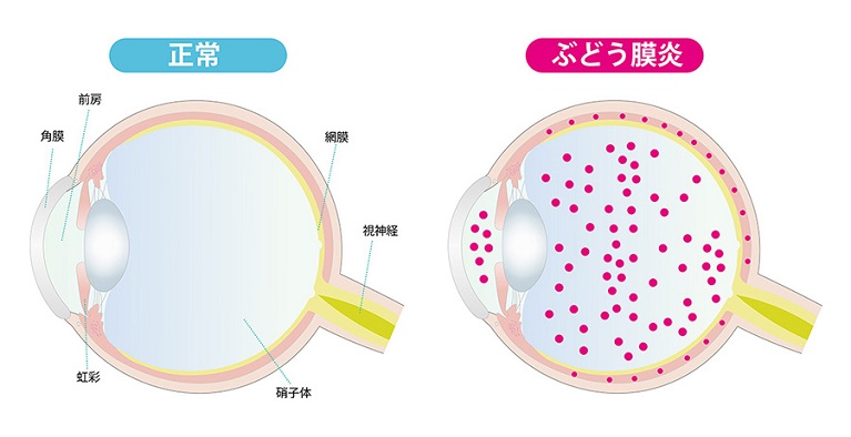 どう膜炎