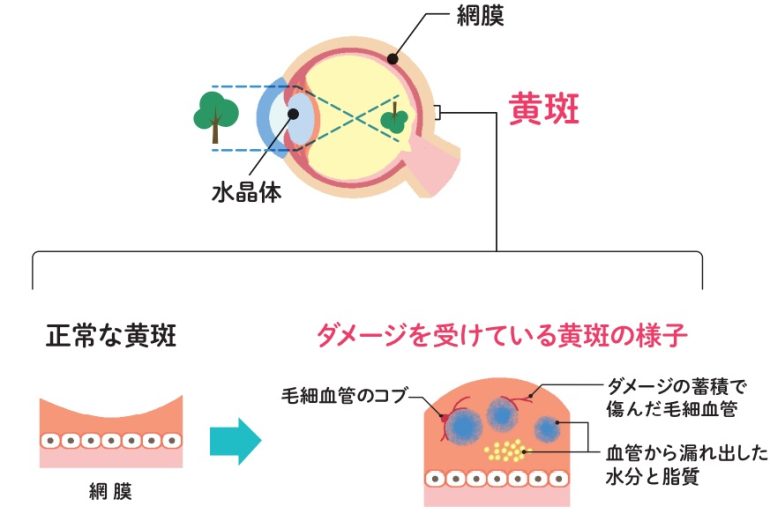 糖尿病黄斑浮腫