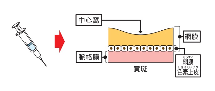 抗血管新生療法（抗VEGF治療薬）