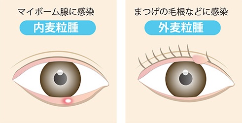 麦粒腫(ものもらい)