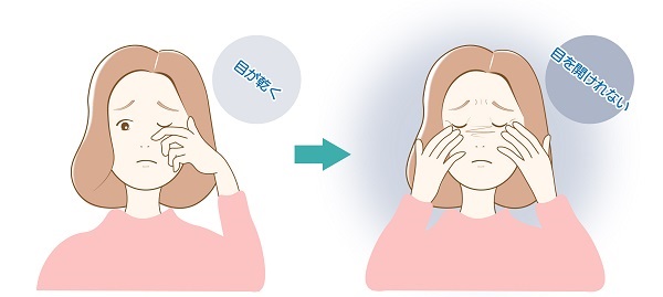 眼瞼けいれん