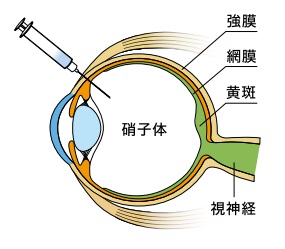 抗VEGF薬治療（硝子体内注射）とはどのような治療？